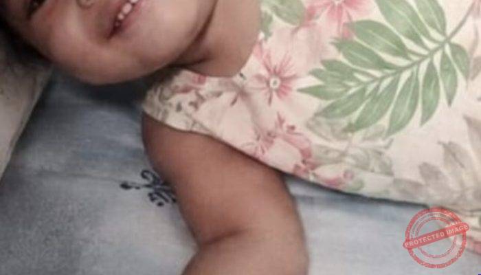 Operasi Tertunda, Balita 19 Bulan Penderita Meningitis dan Thalasemia Mayor Butuh Perhatian