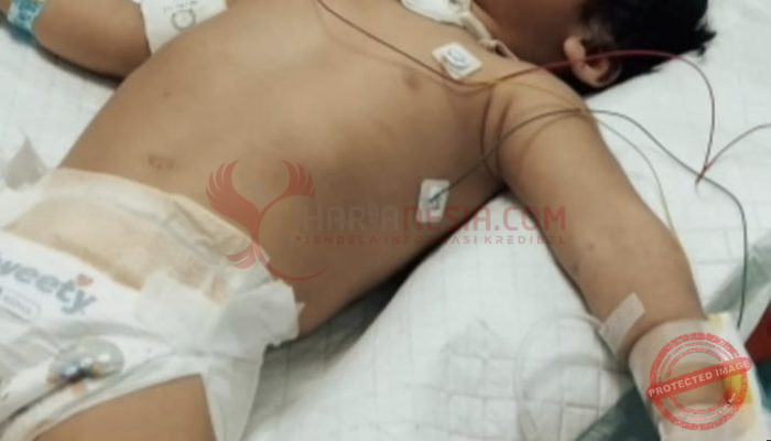 Balita Pejuang Trakeostomi di Bojong Gede Butuh Uluran Tangan, Kanul Merek Shiley PO Singapura dan Susu Khusus Tak Tercover